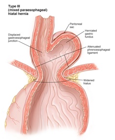 Cirujano Hernia hiato y reflujo gastrico