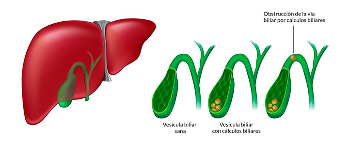 Piedras en la vesícula biliar cálculos en la vesícula Colecistectomía sin cicatriz