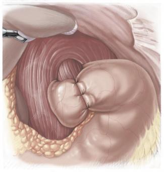 Funduplicatura de Nissen laparoscopica